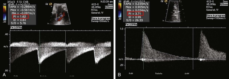 blocked premature atrial contractions