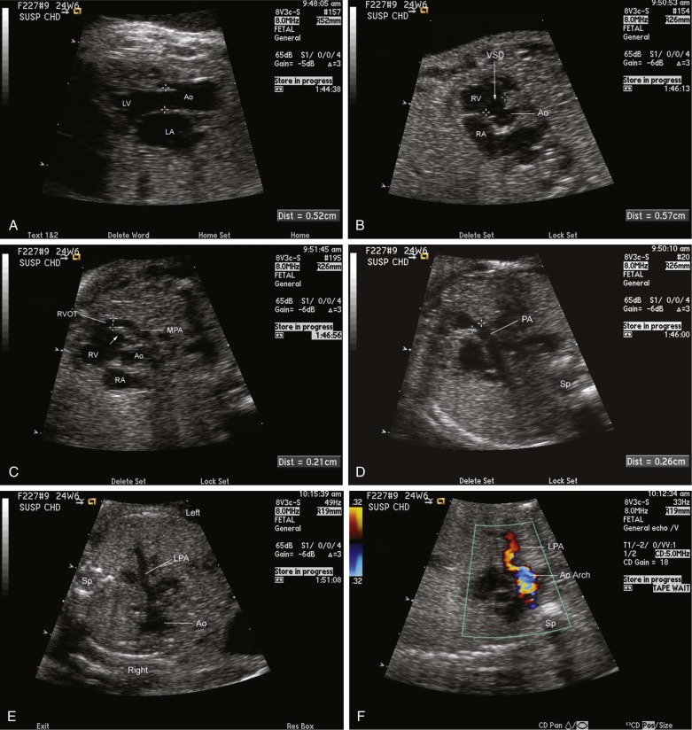 Tetralogy of Fallot | Radiology Key