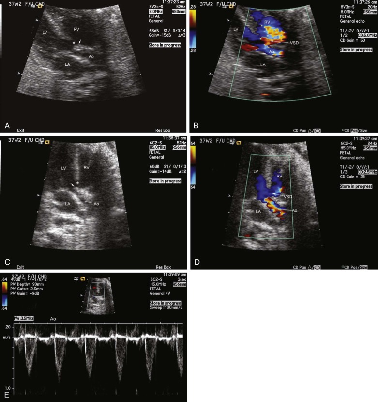 Malalignment of Conal Septum with Arch Obstruction | Radiology Key