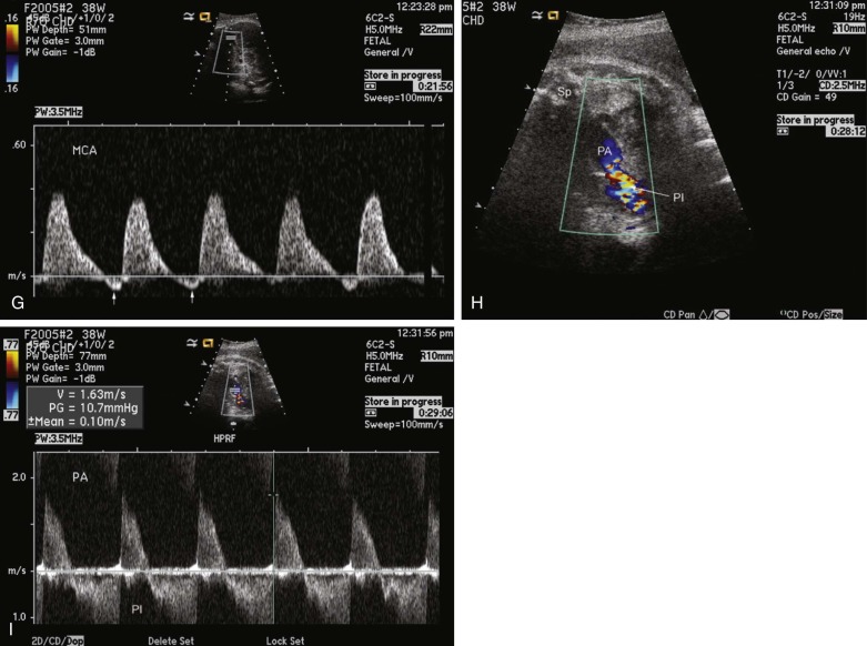 Aortopulmonary Window | Radiology Key