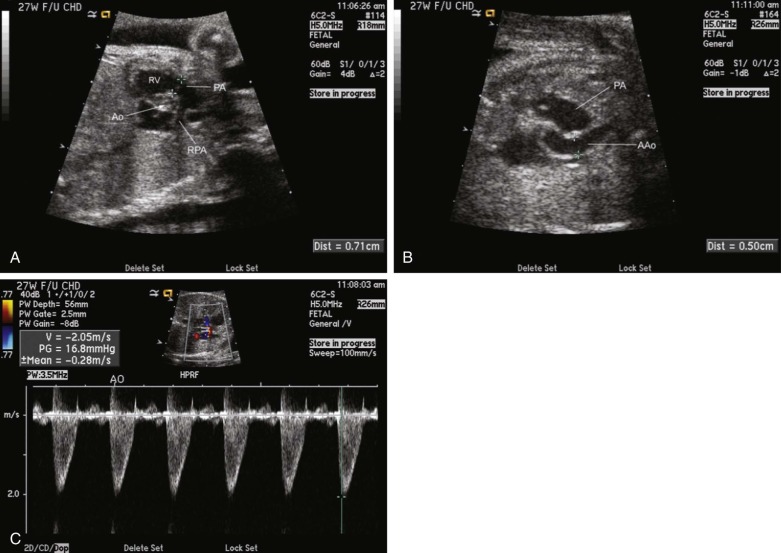 Aortic Stenosis Radiology Key