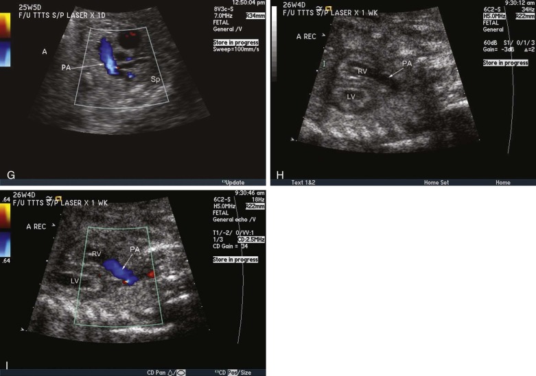 Twin-Twin Transfusion Syndrome | Radiology Key