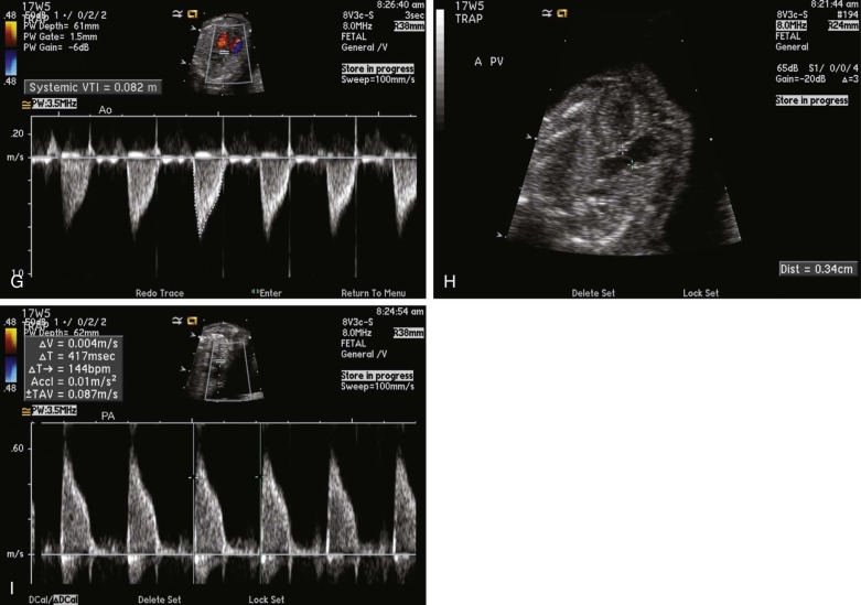 twin-reverse-arterial-perfusion-radiology-key