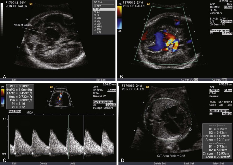 Cerebral Arteriovenous Malformation Radiology Key 5064