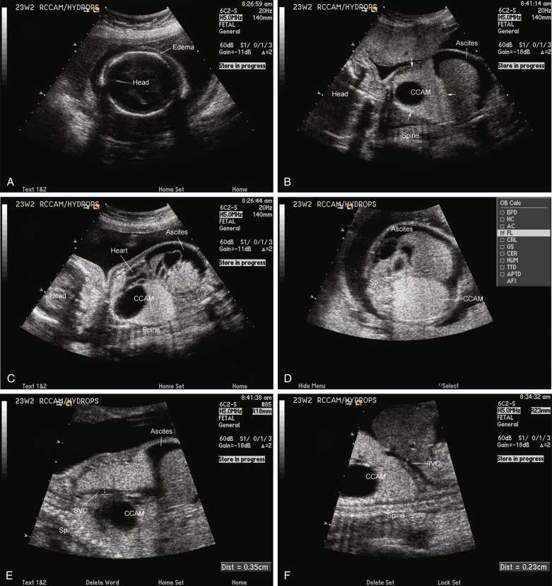 congenital-cystic-adenomatoid-malformation-radiology-key