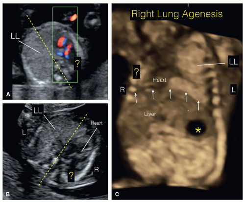 The Fetal Chest | Radiology Key