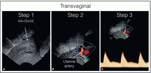 The Detailed First Trimester Ultrasound Examination Radiology Key 