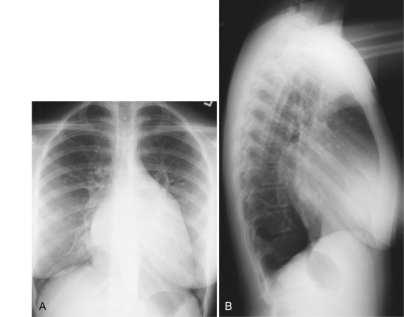 Truncus Arteriosus X Ray
