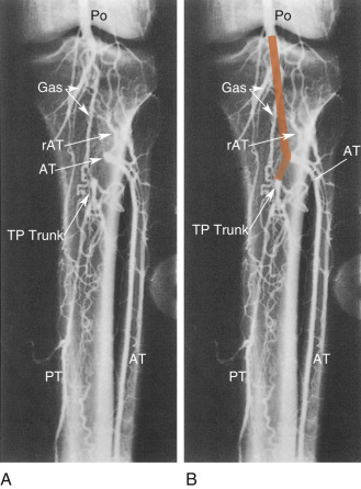 Anatomy Of The Upper And Lower Extremity Arteries | Radiology Key