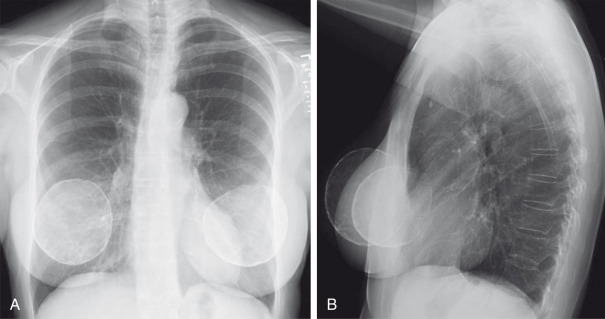 Breast | Radiology Key