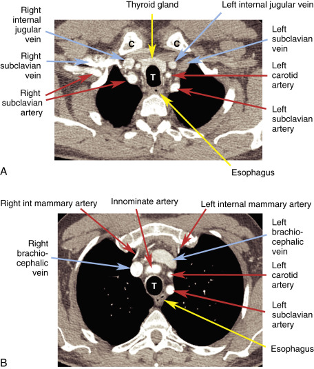 Mediastinum: Introduction and Normal Anatomy | Radiology Key