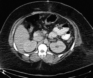 Introduction to CT of the Abdomen and Pelvis | Radiology Key