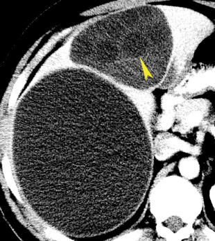 Liver | Radiology Key