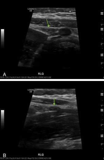 Abdominal Ultrasound   F21-12-9780323596428