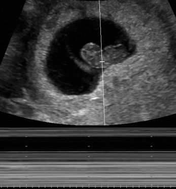 Female Pelvis, Pregnant: First Trimester | Radiology Key