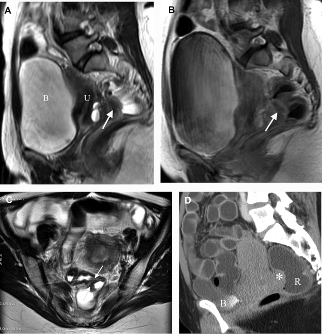 Resonance Enema in Rectosigmoid Endometriosis Radiology Key