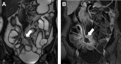 Magnetic Resonance in Crohn’s Disease | Radiology Key