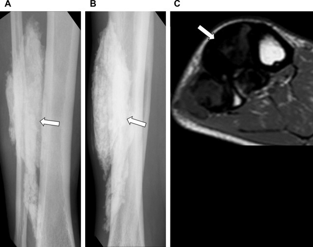 Radiographic/MR Imaging Correlation of Soft Tissues | Radiology Key