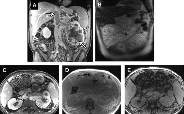 Malabsorption Syndromes, Vasculitis, and Other Uncommon Diseases ...