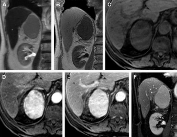 brachial plexus injury mri