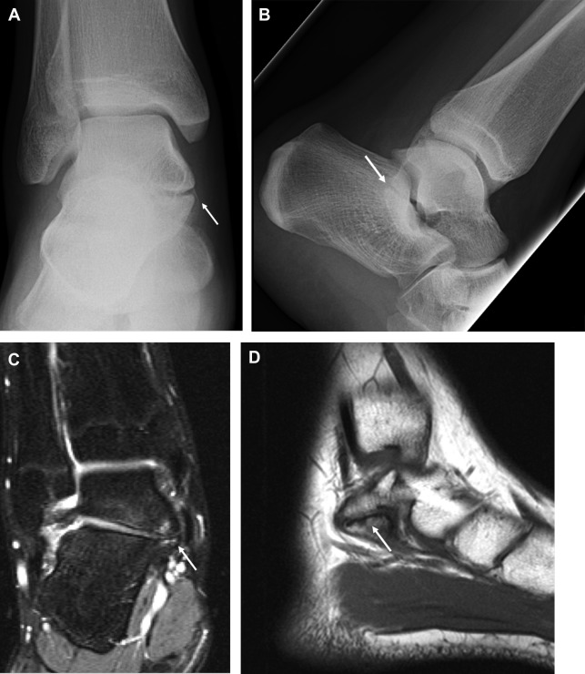 Anteroposterior Radiograph of the Ankle with Cross-Sectional Imaging ...