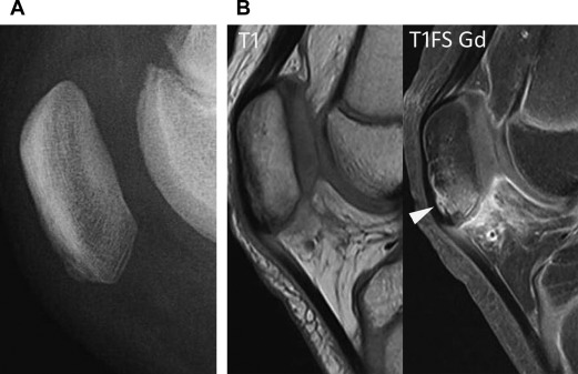 Radiographic/MR Imaging Correlation Of The Pediatric Knee Growth ...