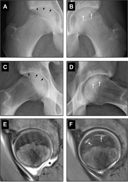 Conventional Radiography Of The Hip Revisited Radiology Key