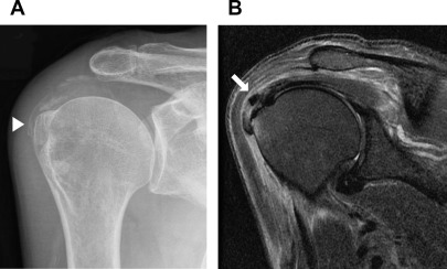 Radiographic/MR Imaging Correlation of the Shoulder | Radiology Key