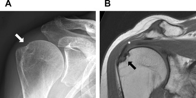 Radiographic/MR Imaging Correlation of the Shoulder | Radiology Key