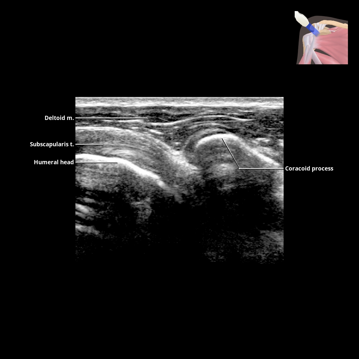 Shoulder | Radiology Key