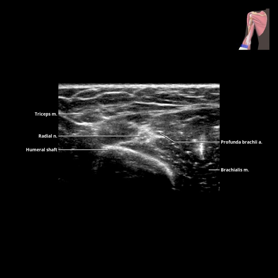 Median Nerve | Radiology Key