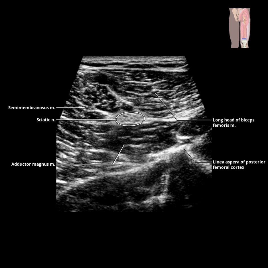 Radial Nerve | Radiology Key