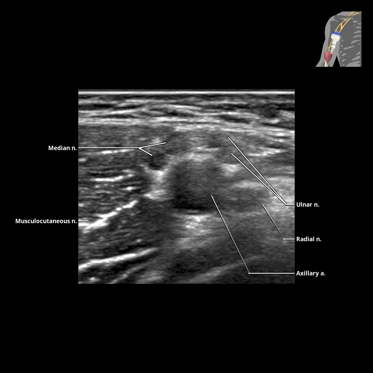 Brachial Plexus | Radiology Key