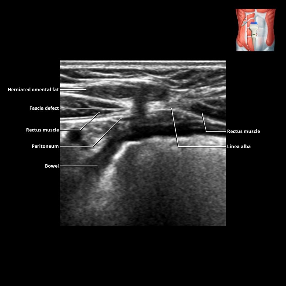 Axilla | Radiology Key