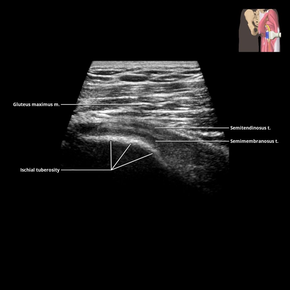 Thigh Muscles | Radiology Key