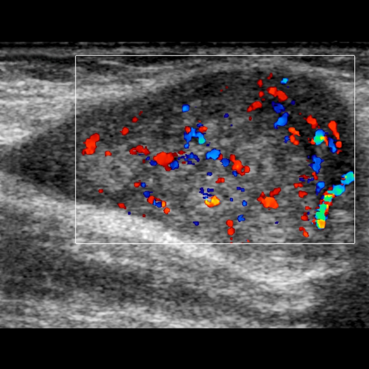 malignant-transformation-of-a-peripheral-nerve-sheath-tumour-in