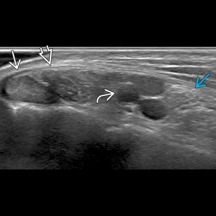 Tarsal Tunnel Syndrome X Ray at Dennis Dyck blog