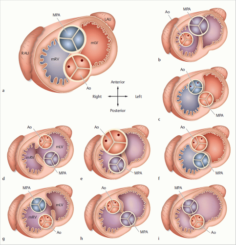 Cardiogenesis And Classification Of Congenital Heart Defects ...