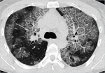 Persistent or Migratory Pulmonary Infiltrates