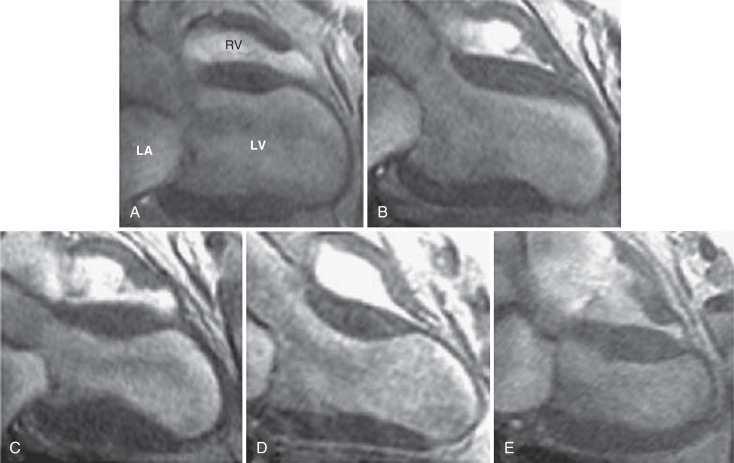 Acute Myocardial Infarction Ventricular Remodeling Radiology Key