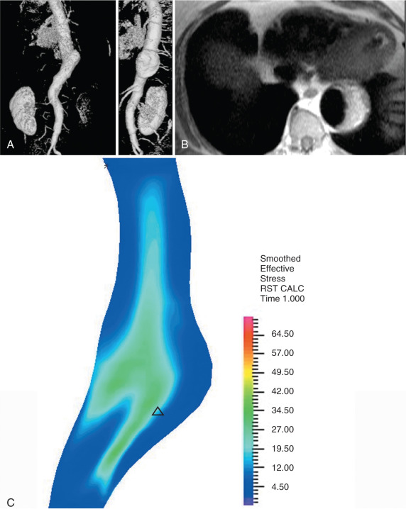 Assessment of the Biophysical Mechanical Properties of the Arterial ...