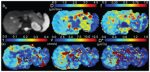 Flow Compensation and Modeling of IVIM MRI in the Liver and Pancreas
