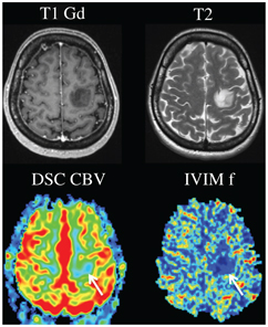 Clinical Applications of IVIM MRI to the Nervous System | Radiology Key