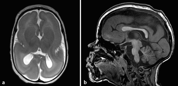 3 Supratentorial Malformations Radiology Key