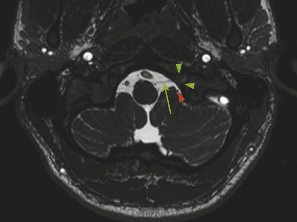 16 Skull Base And Cranial Nerves Radiology Key 4320