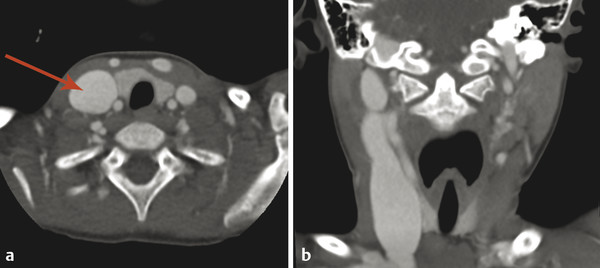 19 Vascular Abnormalities Of The Head And Neck | Radiology Key