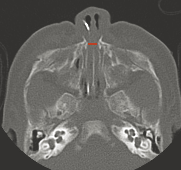 20 Sinuses | Radiology Key