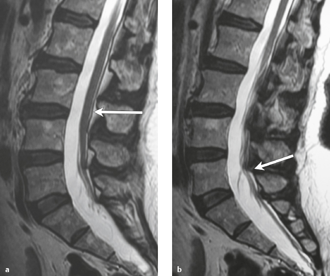 Spine | Radiology Key