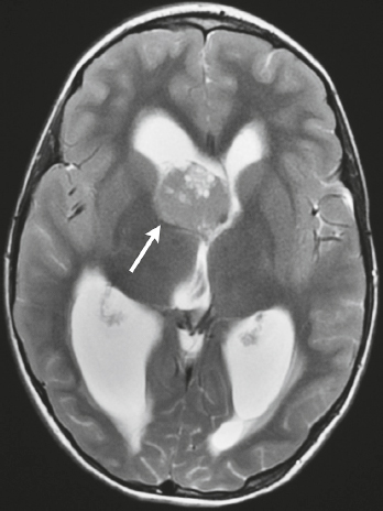 2 Ventricles and Cisterns | Radiology Key
