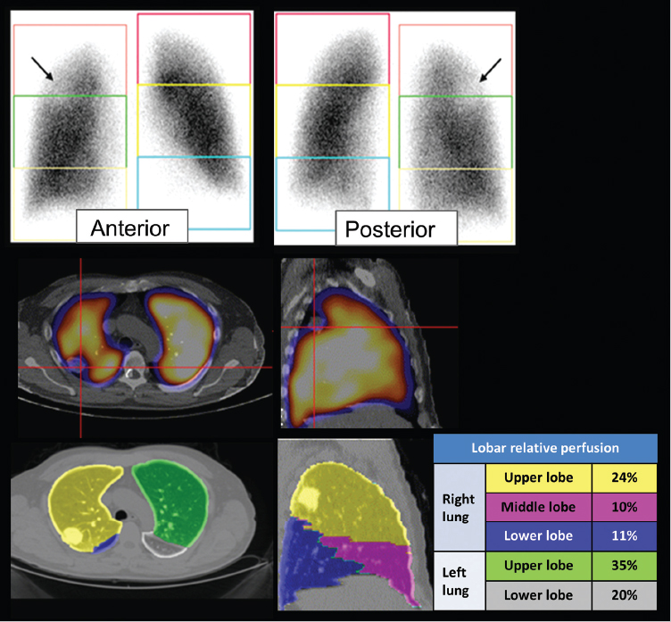 6 SPECT and SPECT/CT for the Respiratory System | Radiology Key